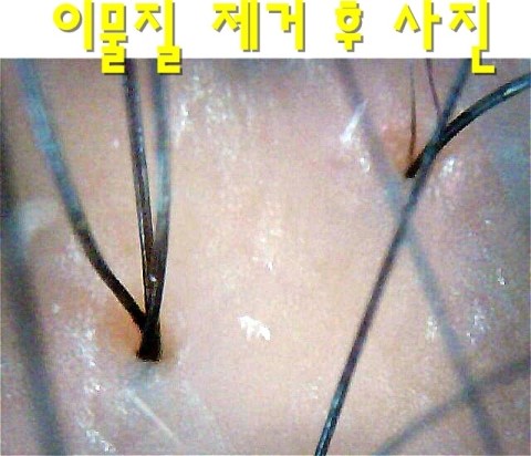탈모 해결 오투 버블기로 해결 하세요. 상담 사례 이미지