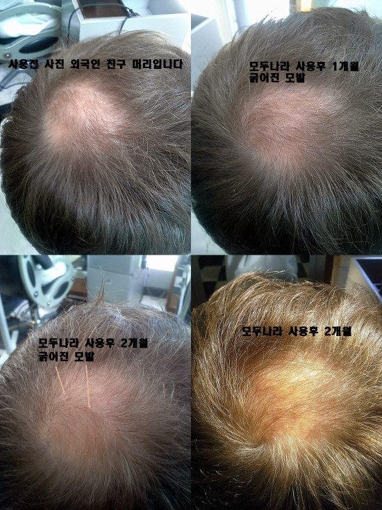 탈모샴푸 어떤거 쓰세요 상담 사례 이미지